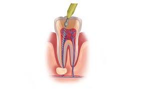 Root canals