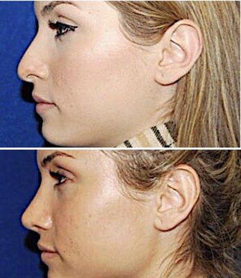 Rhinoplasty