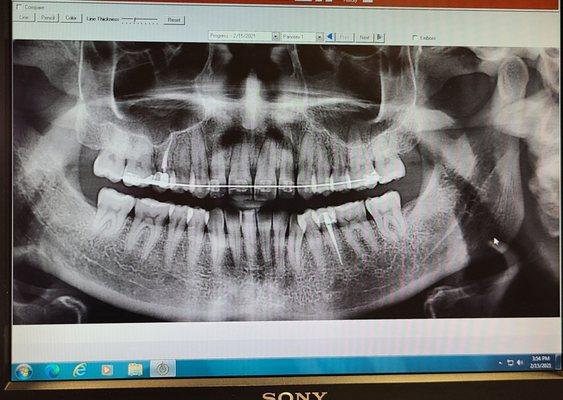 My teef!! We're getting there! =)