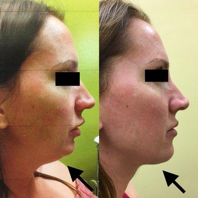 2 Treatments of Kybella, 3 Syringes Juvederm Voluma (2 in cheeks & 1 in chin) for Facial Rejuvenation/Liquid Facelift