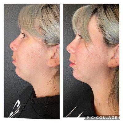 Lip and Chin Filler