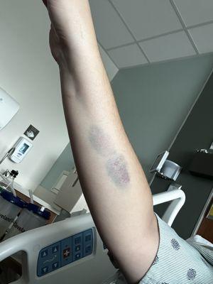 Bruise from iv