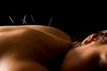 We now offer acupuncture; Individual treatments or group session in in relaxation lounge.