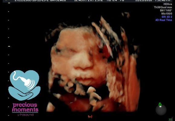 HD Live ultrasound