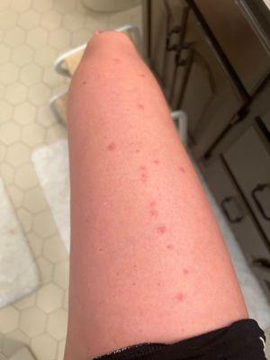 Bed bug bites