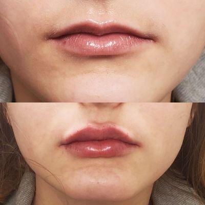 lip filler dec 2022 from laura :)