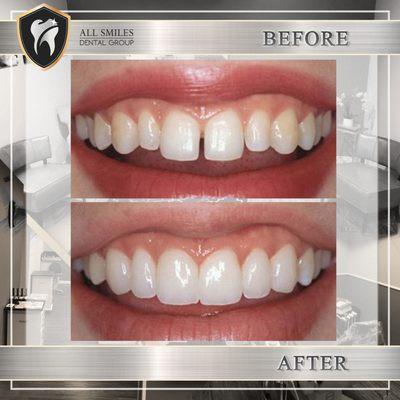 fixing the gap between front teeth and unevenness of other teeth with veneers