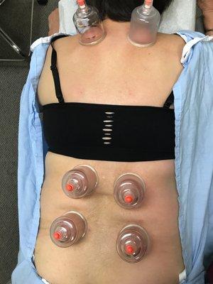 cupping theraphy for low back pain