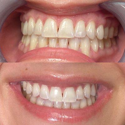 Maintenance is key to a white smile!