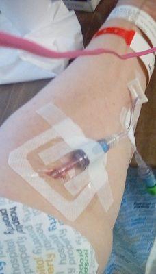 5th IV in 4 days - was bleeding outside the vein - took 3 hours to get it changed