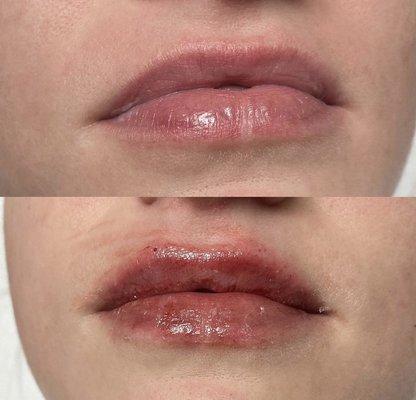 1 ml Lip filler