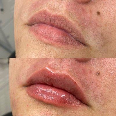 Before and after, received lip filler