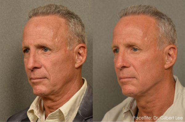 #FaceTite scarless surgery. A Scarless Face Lift restores definition to a sagging jawline.