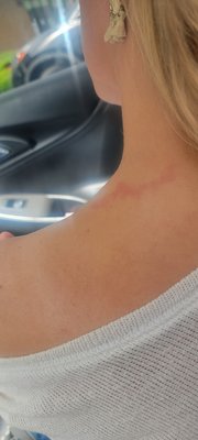 Burn from neck wrap