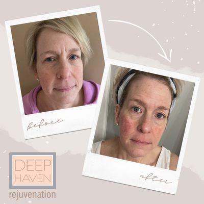 DeepHaven Rejuvenation