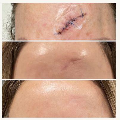 Virtue Microneedling to treat scars.