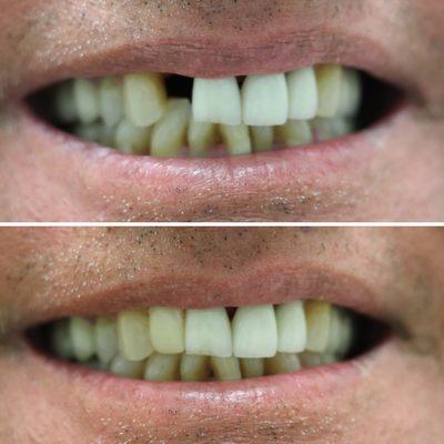 Mising a tooth? Aesthetic solutions to get you a full smile quickly and efficiently. Work done by Dr. Kevin Jan.