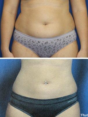 Upper and lower abdomen before and after liposuction