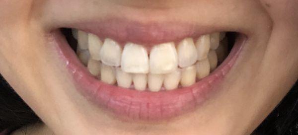 After Invisalign