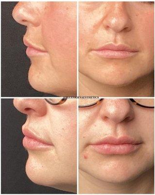 Before & After Kysse Lip filler done by NP-Injector Candis Layton.