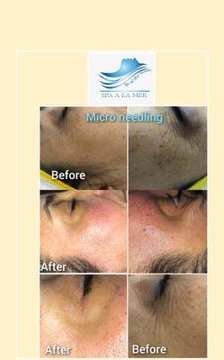 Micro-needling Unlock the Transformative Power for Your Skin. It can bring your skin 10 years younger.