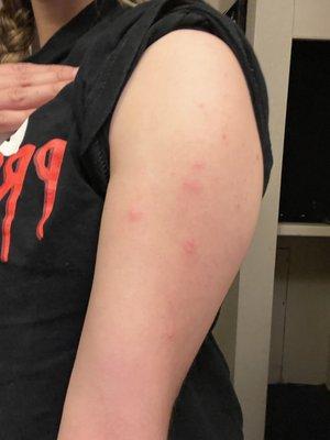 Bed bug bites on right arm