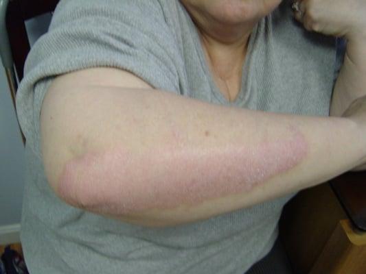 Psoriasis: after