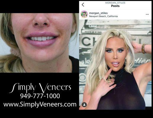 Simply Veneers