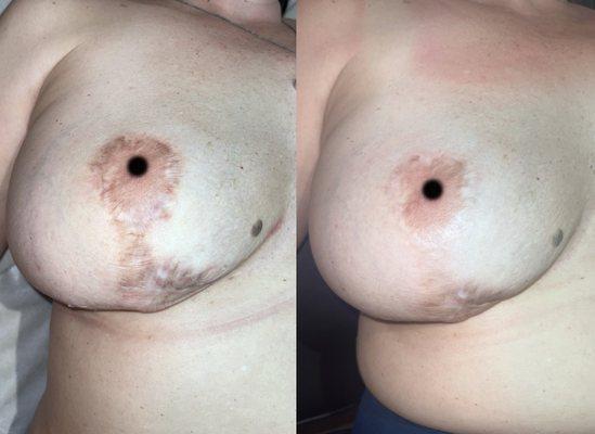 This client underwent a breast augmentation/lift and was allergic to the tape used in recovery. These results are after 1 treatment !