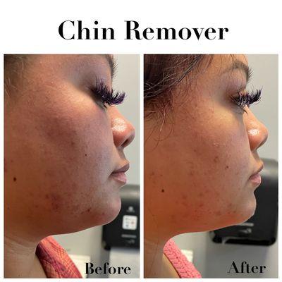 Chin removal