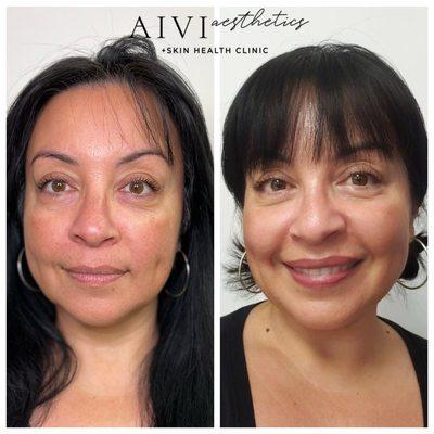 Before and After Microneedling Treatment