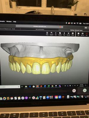 Dr. Parikh digitally designing and printing an Implant All on 4 case.