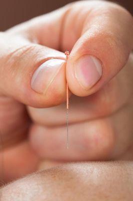 TCM Acupuncture