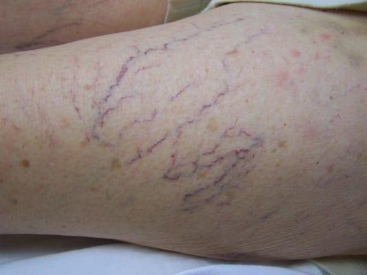 Before Sclerotherapy treatment for spider veins.