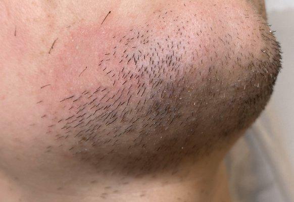 Transgender chin hair with electrolysis permanent hair removal!