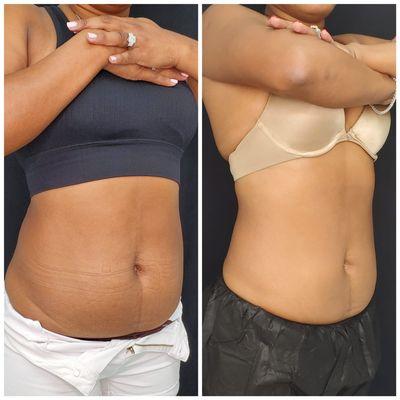 Coolsculpting