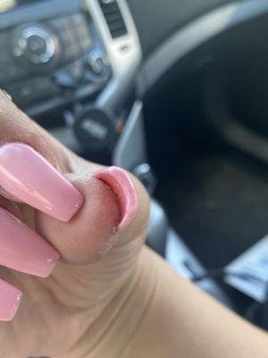 Blood under nail