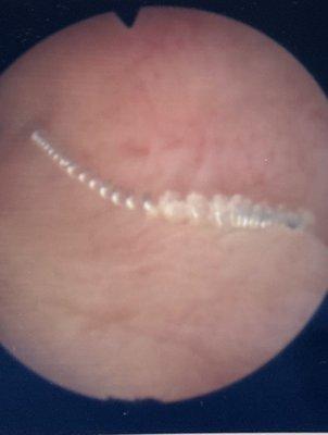 My essure coil in my uterus (not performed by Dr Cizmar) just showing that they were not in place.