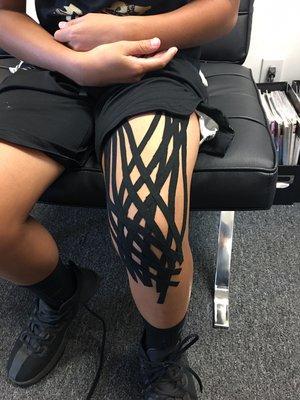 Kinesiotape to reduce swelling after ACL surgery