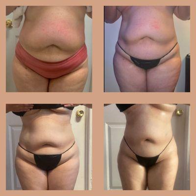 Body Sculpting 
Before and After 
No surgery!!!