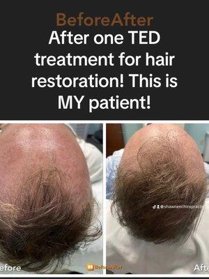 ALMA TED for painFREE hair restoration!