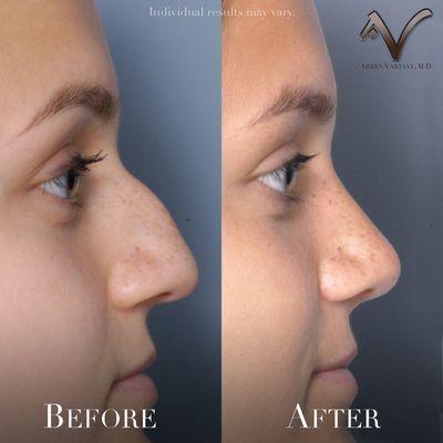 Side View. Before and After Rhinoplasty.