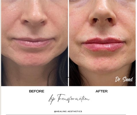 Lip filler with natural look.