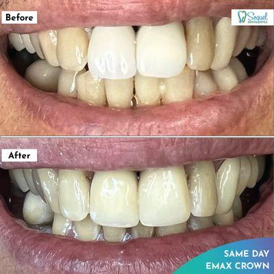 Dr. Shyba beautifully restored this patient's smile with 2 custom shaded and stained Emax crowns.