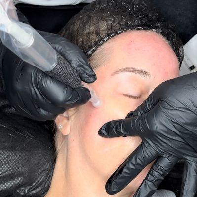 Microneedling