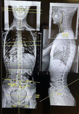 Full Spine X-rays