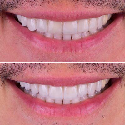 Veneers revision