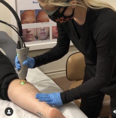 Laser hair removal