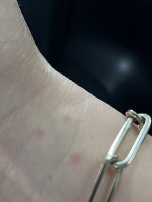 Bed bug bites