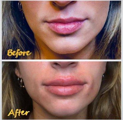 Lip Flips are a procedure in which botox is administered into muscles around the mouth, resulting in a pronounced pout.